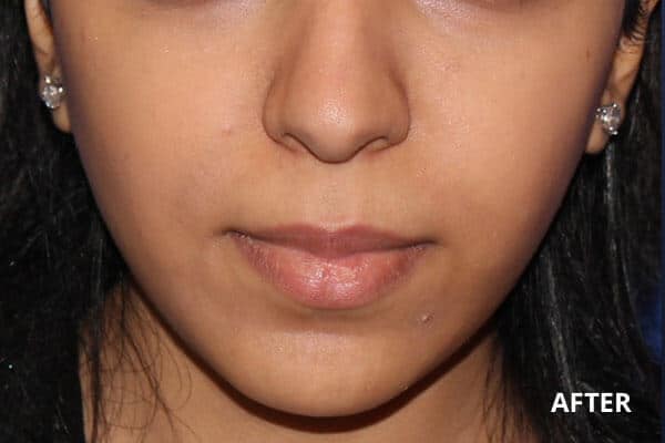 Buccal Fat Removal After Buccal Fat Removal After