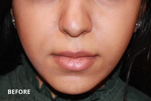 Buccal Fat Removal Before Buccal Fat Removal Before