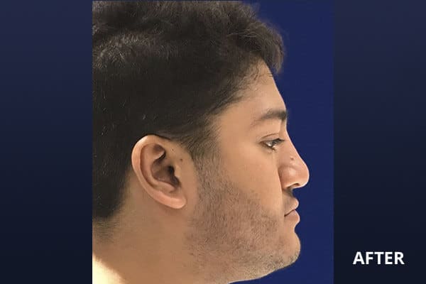 Liquid Rhinoplasty Before and After Pictures Long Island & Manhattan, NY Liquid Rhinoplasty Before and After Pictures Long Island & Manhattan, NY