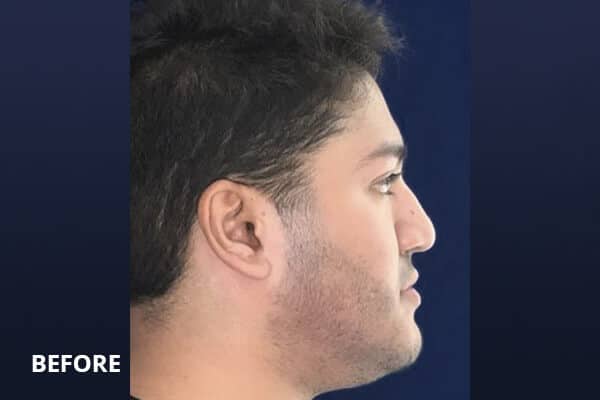 Liquid Rhinoplasty Before and After Pictures Long Island & Manhattan, NY Liquid Rhinoplasty Before and After Pictures Long Island & Manhattan, NY