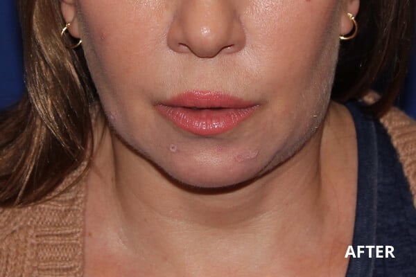 After Ultherapy After Ultherapy
