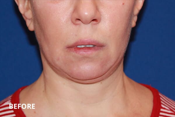Before Ultherapy Before Ultherapy
