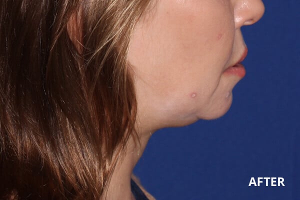 After Ultherapy After Ultherapy