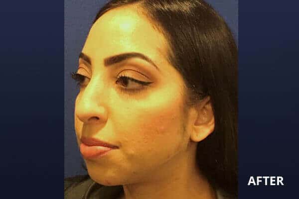After jawline contouring After jawline contouring