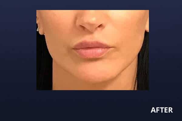 Lip Lift After Lip Lift After