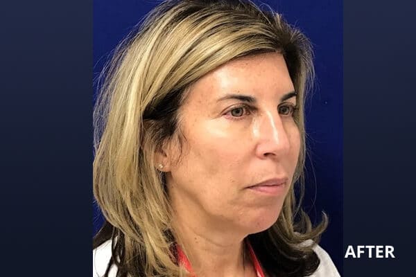 After upper bleph & lower face Ultherapy After upper bleph & lower face Ultherapy