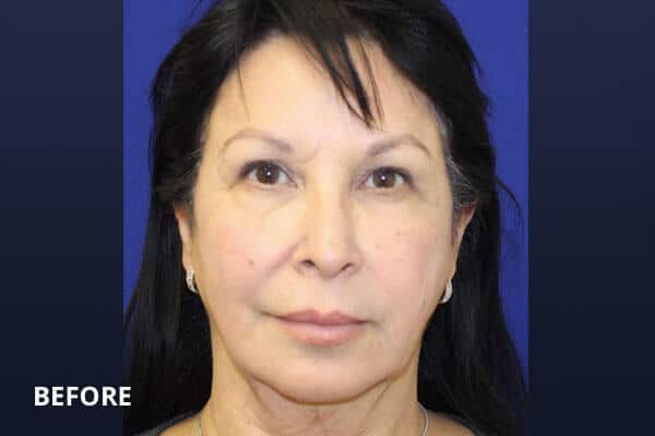 Buccal Fat Before Buccal Fat Before