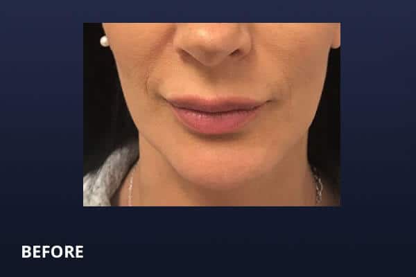 Lip Lift Before Lip Lift Before