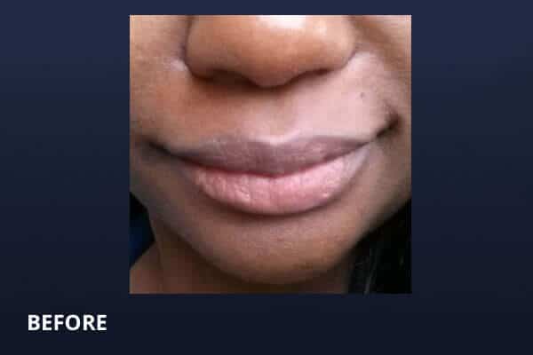 Lip Lift Before Lip Lift Before