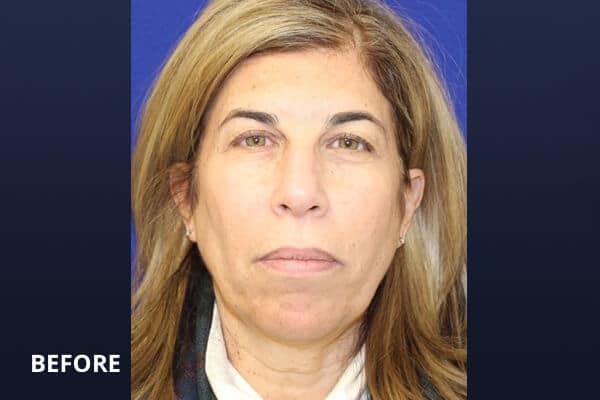 Before upper bleph & lower face ultherapy Before upper bleph & lower face ultherapy