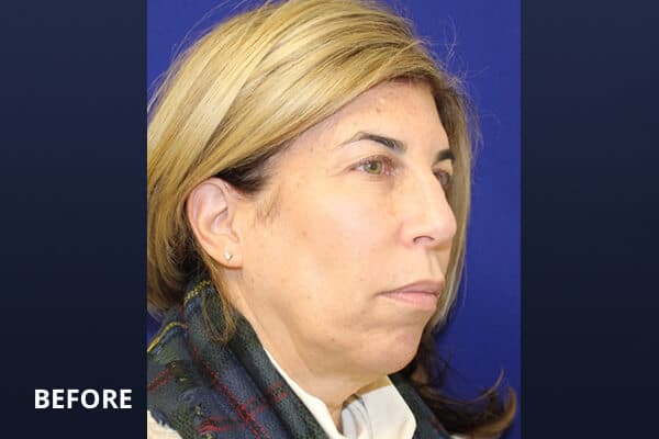 Before upper bleph & lower face ultherapy Before upper bleph & lower face ultherapy