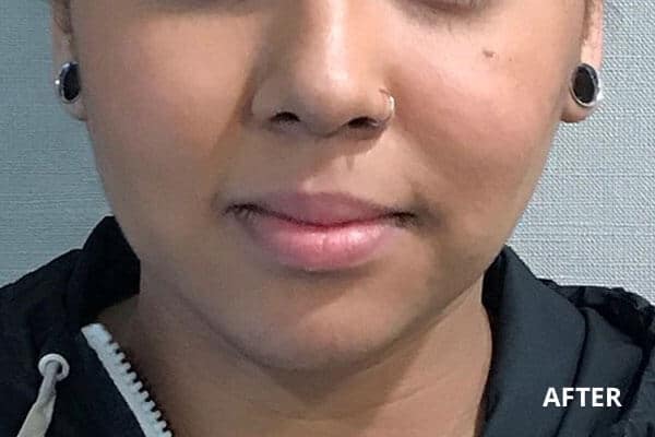 Buccal fat removal after Buccal fat removal after