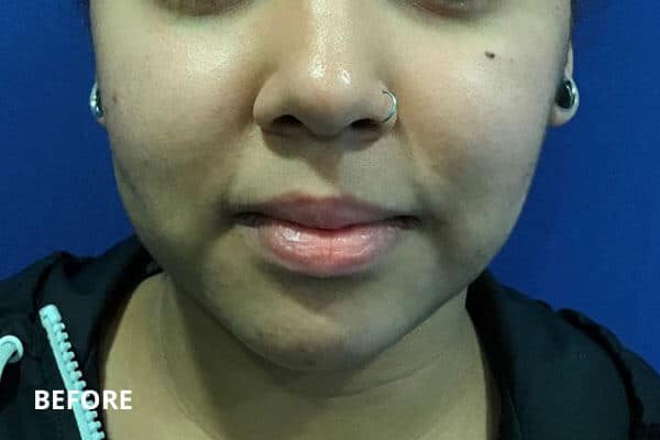 Buccal Fat Removal Before and After Pictures Long Island & Manhattan, NY