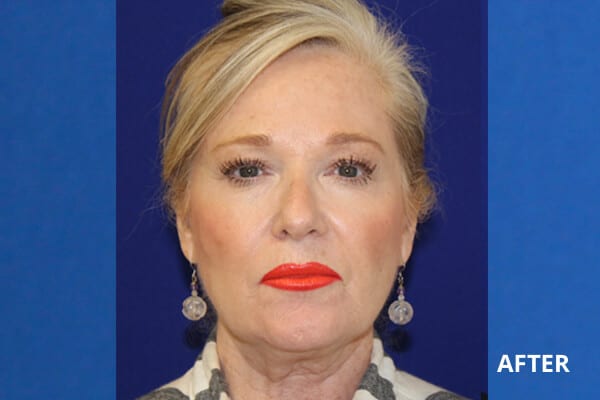 Cheek Filler Before and After Pictures Long Island & Manhattan, NY Cheek Filler Before and After Pictures Long Island & Manhattan, NY