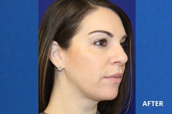 Cheek Filler Before and After Pictures Long Island & Manhattan, NY Cheek Filler Before and After Pictures Long Island & Manhattan, NY