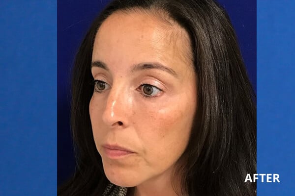 Cheek Filler Before and After Pictures Long Island & Manhattan, NY