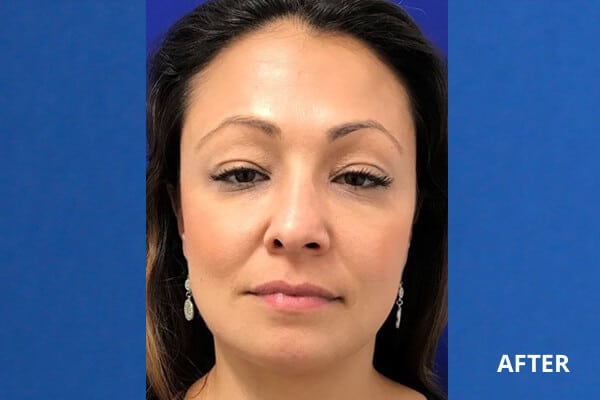 Cheek Filler Before and After Pictures Long Island & Manhattan, NY Cheek Filler Before and After Pictures Long Island & Manhattan, NY