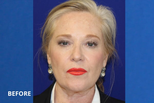 Cheek Filler Before and After Pictures Long Island & Manhattan, NY Cheek Filler Before and After Pictures Long Island & Manhattan, NY