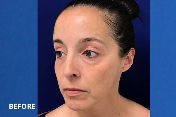 Cheek Filler Before and After Pictures Long Island & Manhattan, NY Cheek Filler Before and After Pictures Long Island & Manhattan, NY