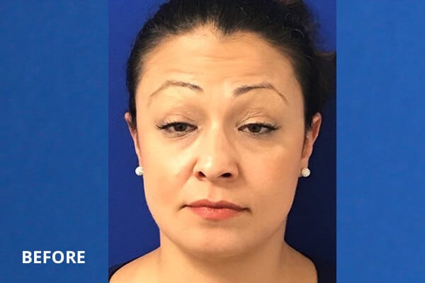 Cheek Filler Before and After Pictures Long Island & Manhattan, NY Cheek Filler Before and After Pictures Long Island & Manhattan, NY