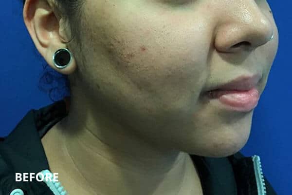 Dr. Madnani buccal fat removal before Dr. Madnani buccal fat removal before