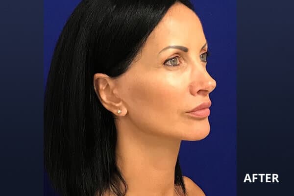 After Minilift Lip Lift After Minilift Lip Lift