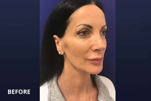 Before Mini lift lip lift Before Mini lift lip lift