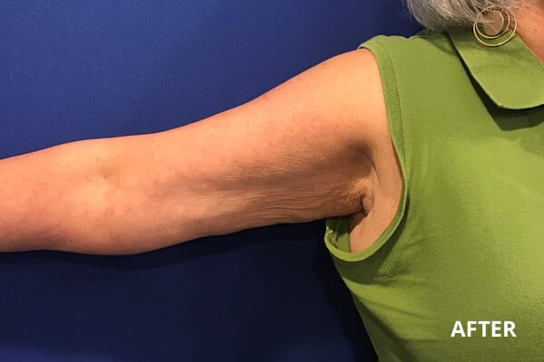 After Inner Arm Ultherapy After Inner Arm Ultherapy