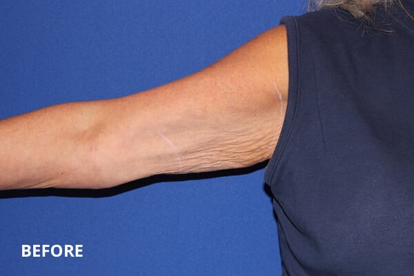 Before Inner Arm Ultherapy Before Inner Arm Ultherapy