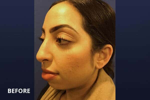 After Jawline contouring After Jawline contouring