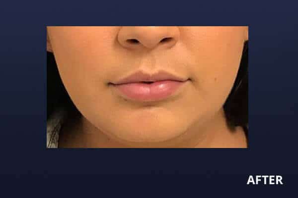 Lip Filler Before and After Pictures Long Island & Manhattan, NY