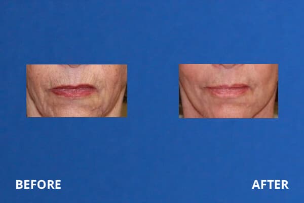 CO2 Laser Resurfacing Before and After Pictures Long Island & Manhattan, NY