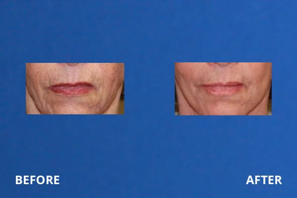 Laser Resurfacing