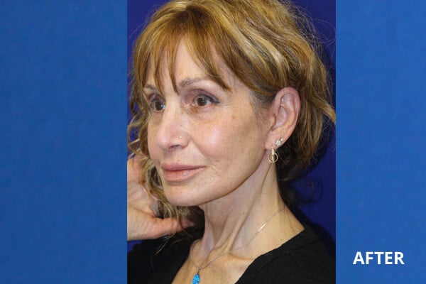 After CO2 Laser Resurfacing After CO2 Laser Resurfacing