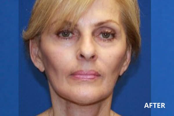 Post Laser Resurfacing Post Laser Resurfacing