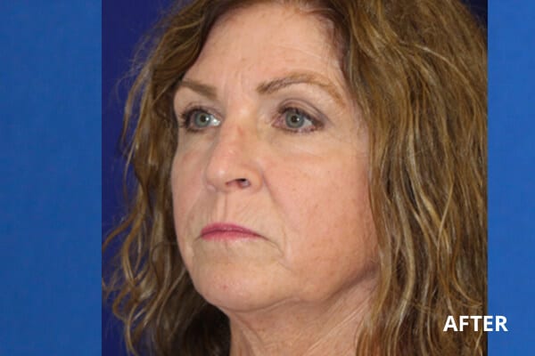 After CO2 Laser Resurfacing After CO2 Laser Resurfacing