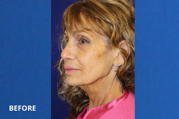 Before CO2 Laser Resurfacing Before CO2 Laser Resurfacing