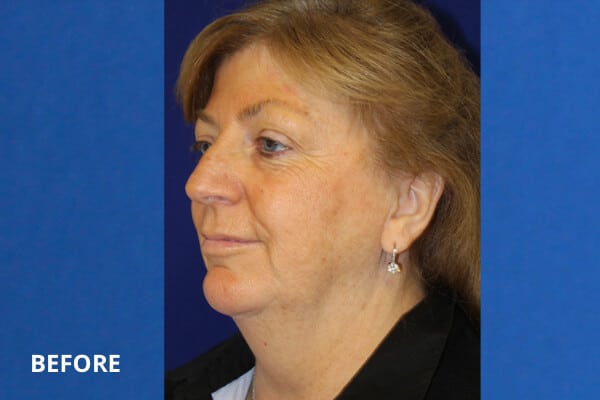 Before CO2 Laser Resurfacing Before CO2 Laser Resurfacing