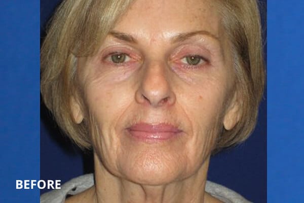 Pre Laser Resurfacing Pre Laser Resurfacing