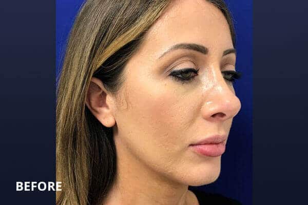 restylane cheek filler before and after post
