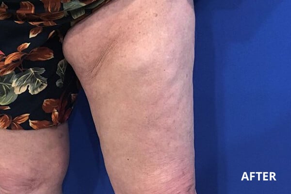 After Ultherapy right After Ultherapy right