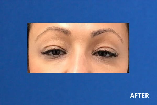 Undereye Filler Before and After Pictures Long Island & Manhattan, NY