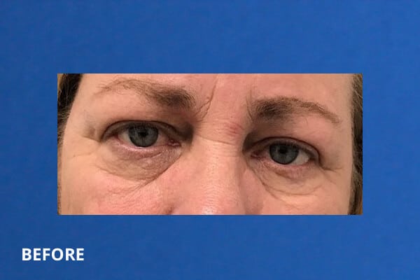 Undereye Filler Before and After Pictures Long Island & Manhattan, NY