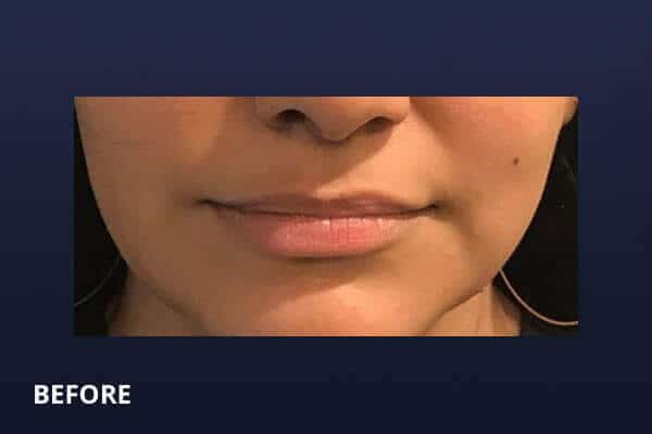 Lip Filler Before and After Pictures Long Island & Manhattan, NY