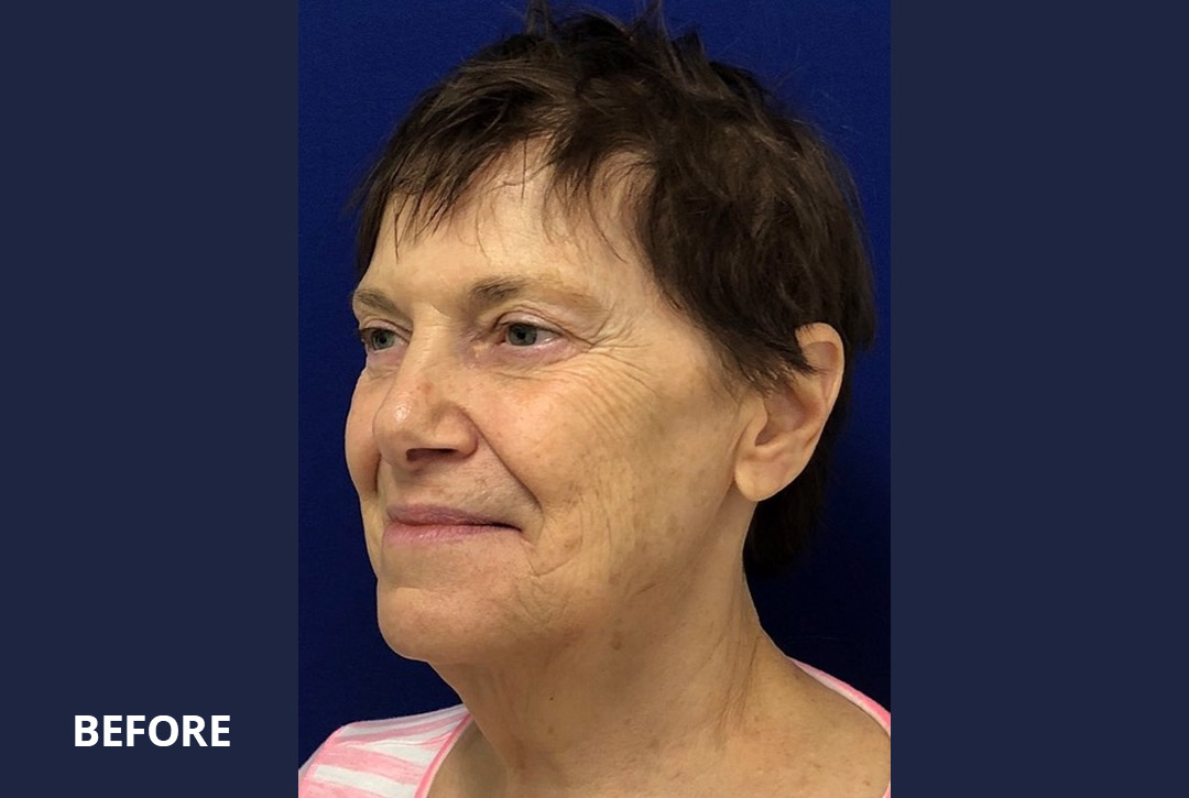 Necklift Before and After Pictures Long Island & Manhattan, NY Necklift Before and After Pictures Long Island & Manhattan, NY