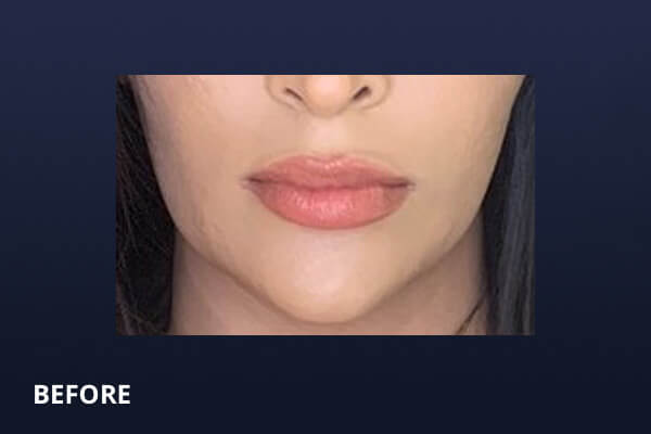 Lip Lift Before and After Pictures Long Island & Manhattan, NY