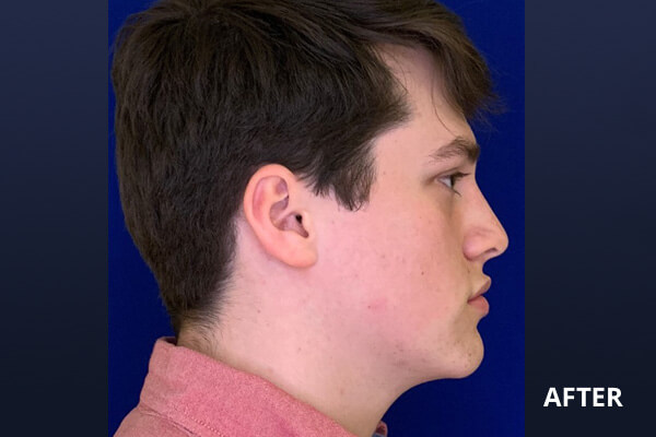 Liquid Rhinoplasty Before and After Pictures Long Island & Manhattan, NY Liquid Rhinoplasty Before and After Pictures Long Island & Manhattan, NY