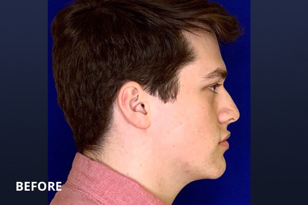 Liquid Rhinoplasty Before and After Pictures Long Island & Manhattan, NY