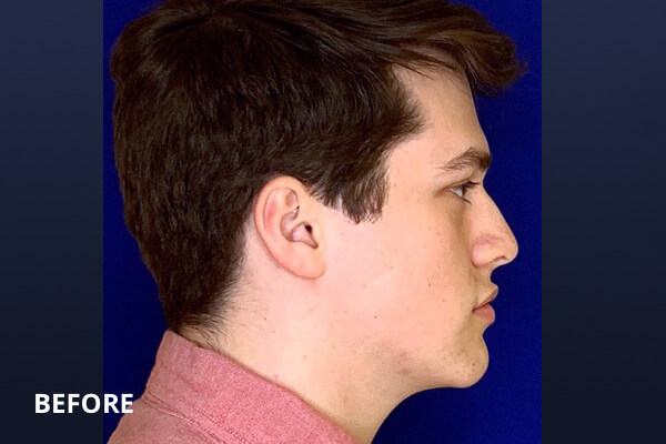 Liquid Rhinoplasty Before and After Pictures Long Island & Manhattan, NY Liquid Rhinoplasty Before and After Pictures Long Island & Manhattan, NY