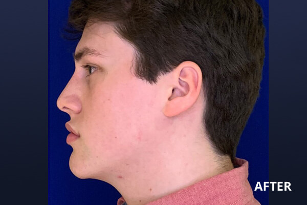 Liquid Rhinoplasty Before and After Pictures Long Island & Manhattan, NY Liquid Rhinoplasty Before and After Pictures Long Island & Manhattan, NY